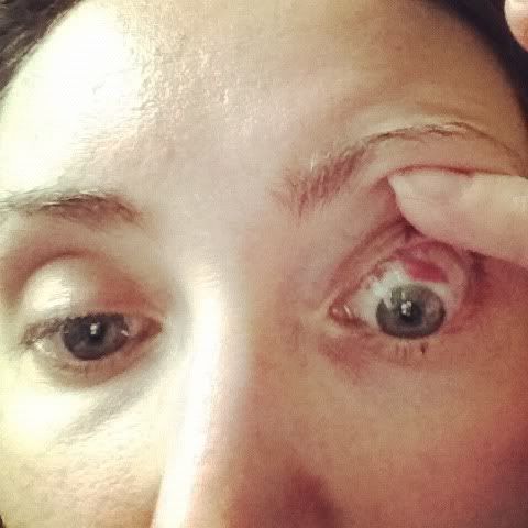 eyeball bruises